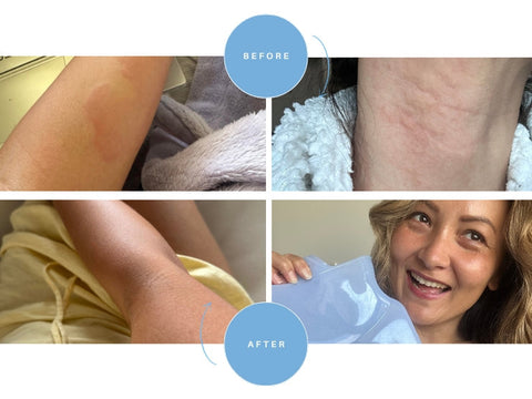 Overcoming Chronic Skin Issues Through Coffee Enemas